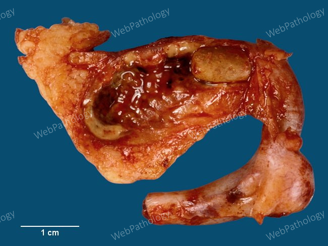 Appendix_Appendicitis_Fecalith1 (1).jpg